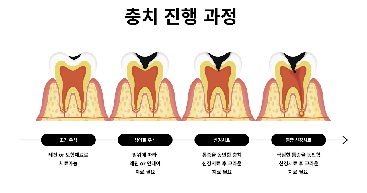 충치 1