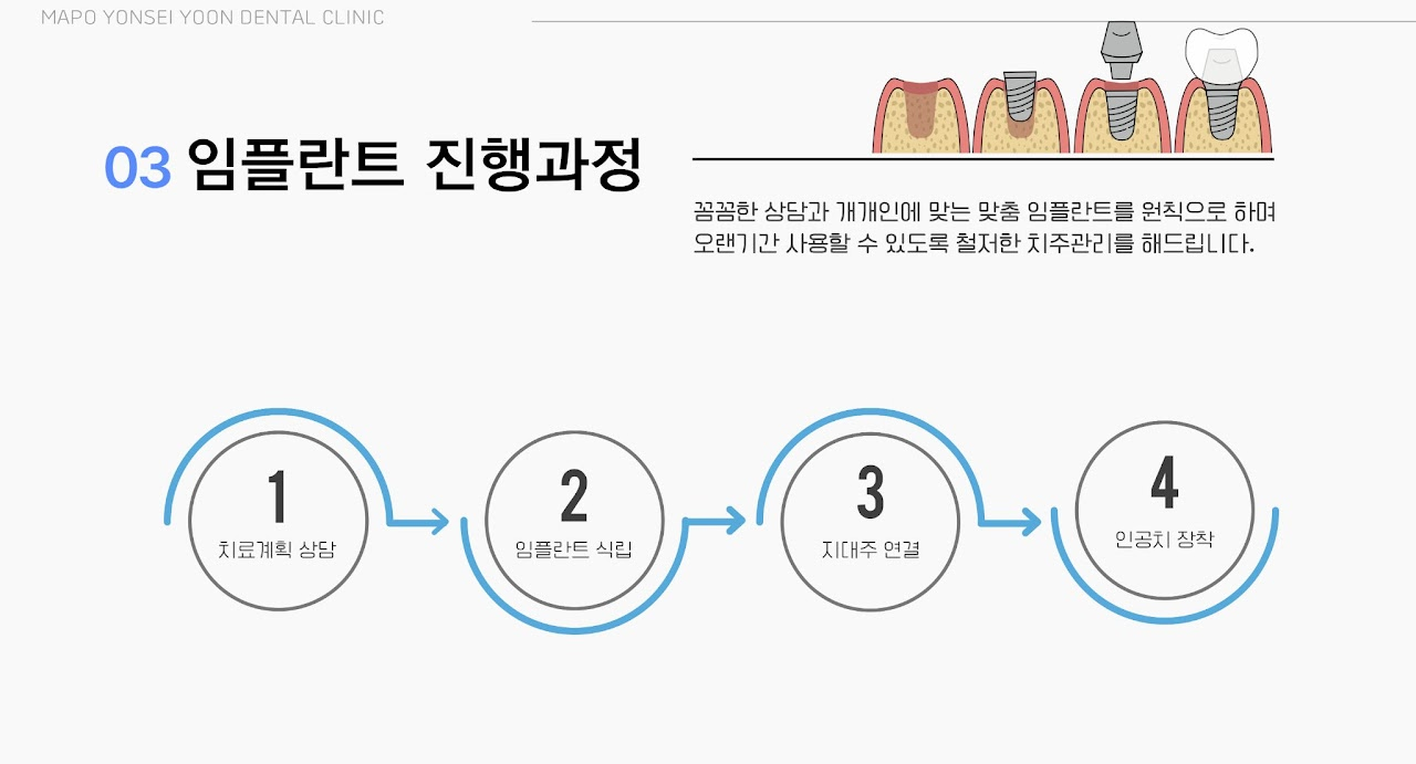 임플란트 4