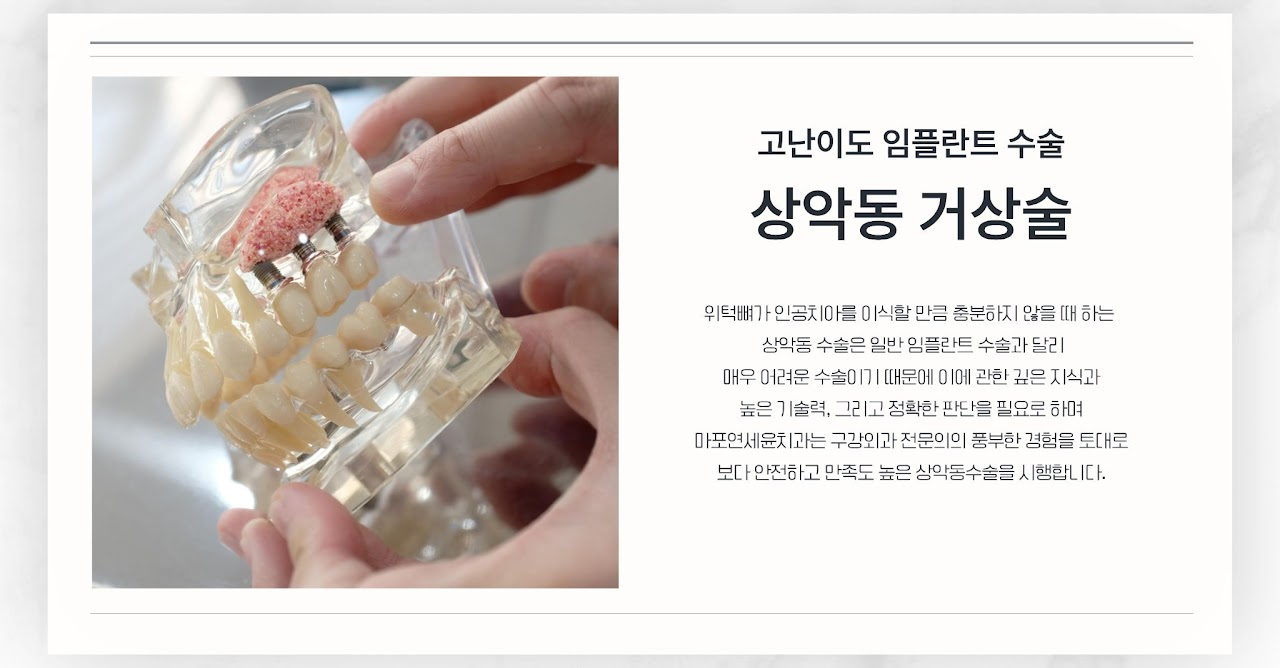 임플란트 5