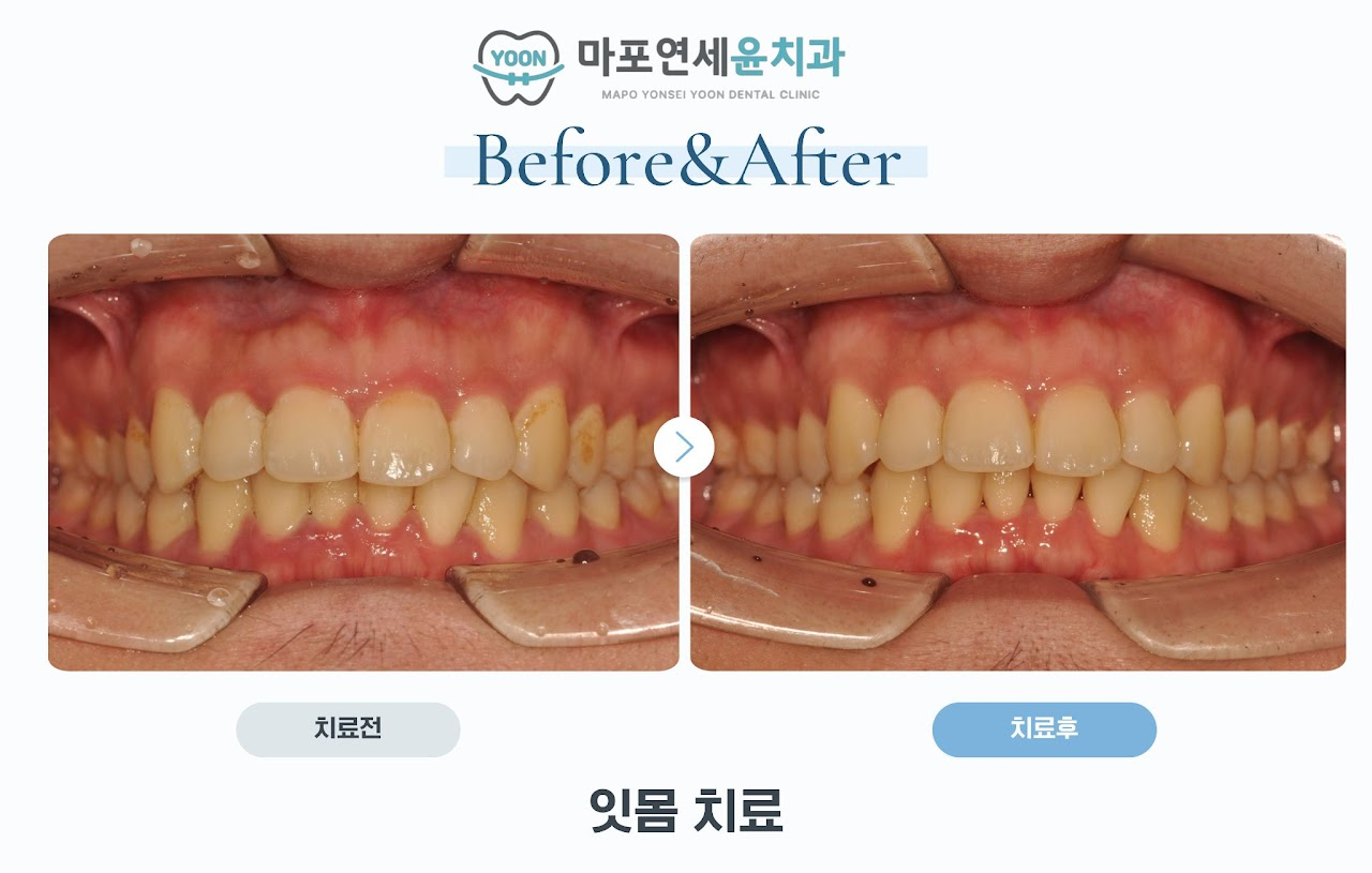 잇몸 3